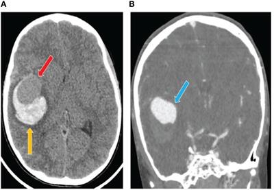Deep Phenotyping of T-Cells Derived From the Aneurysm Wall in a Pediatric Case of Subarachnoid Hemorrhage
